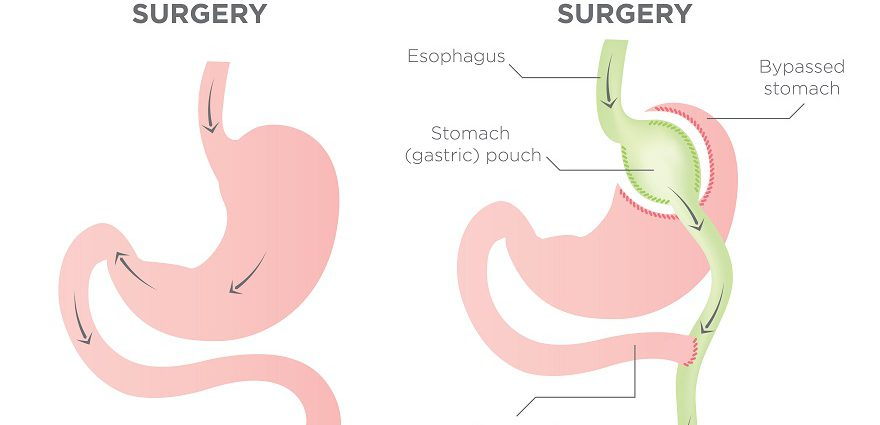 Laparoscopic Mini Gastric Bypass (MGB) vs Sleeve